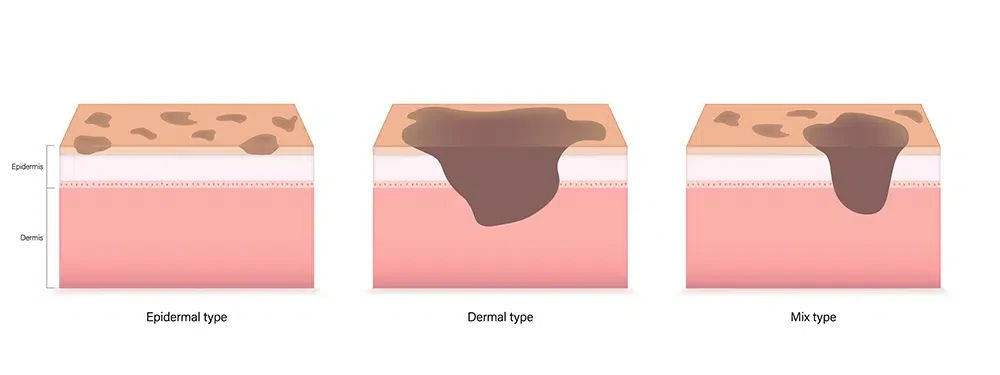 Epidermal, dermal and mixed types of melasma