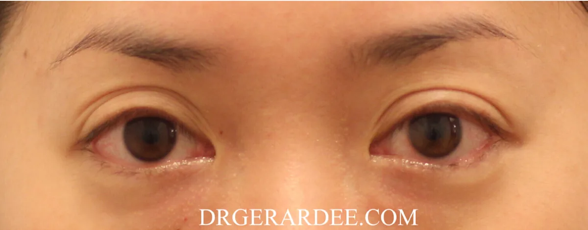 Under-eye area with mild dark eye circles