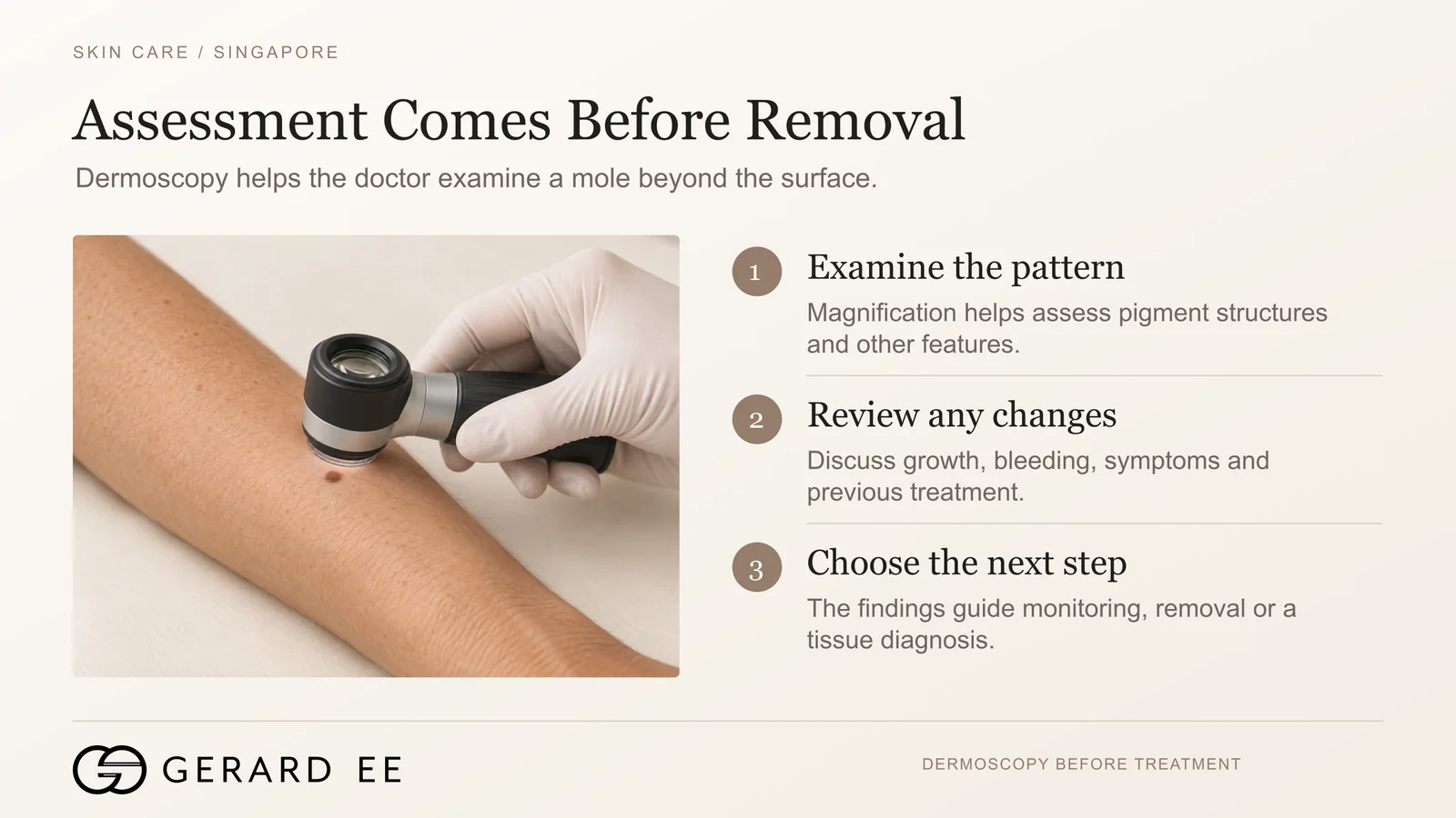 Dermoscopy assessment before mole removal in Singapore, examining the pigment pattern and changes before choosing a method