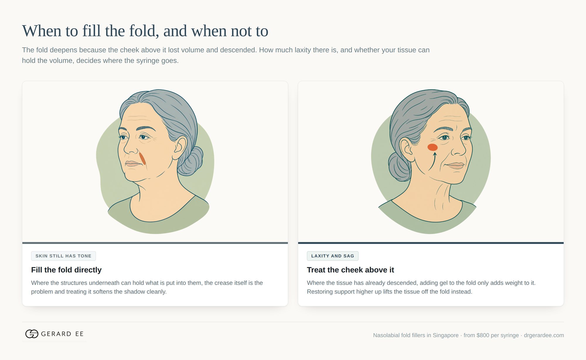 When to fill the nasolabial fold directly and when to treat the cheek above it instead