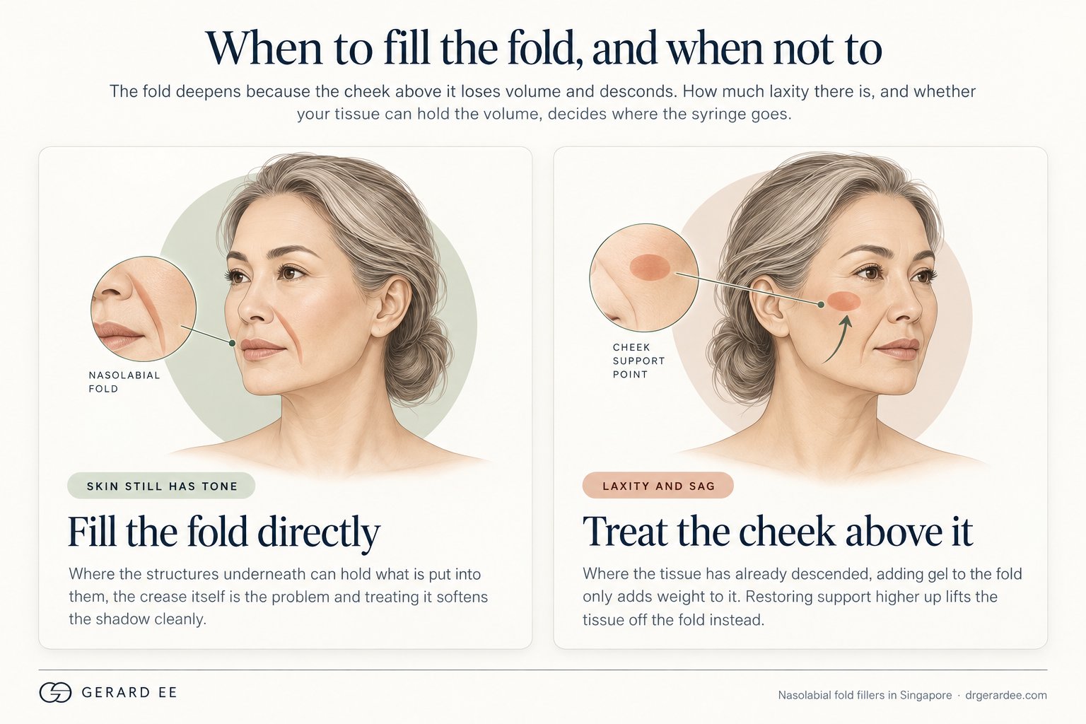 When to fill the nasolabial fold directly and when to treat the cheek above it instead
