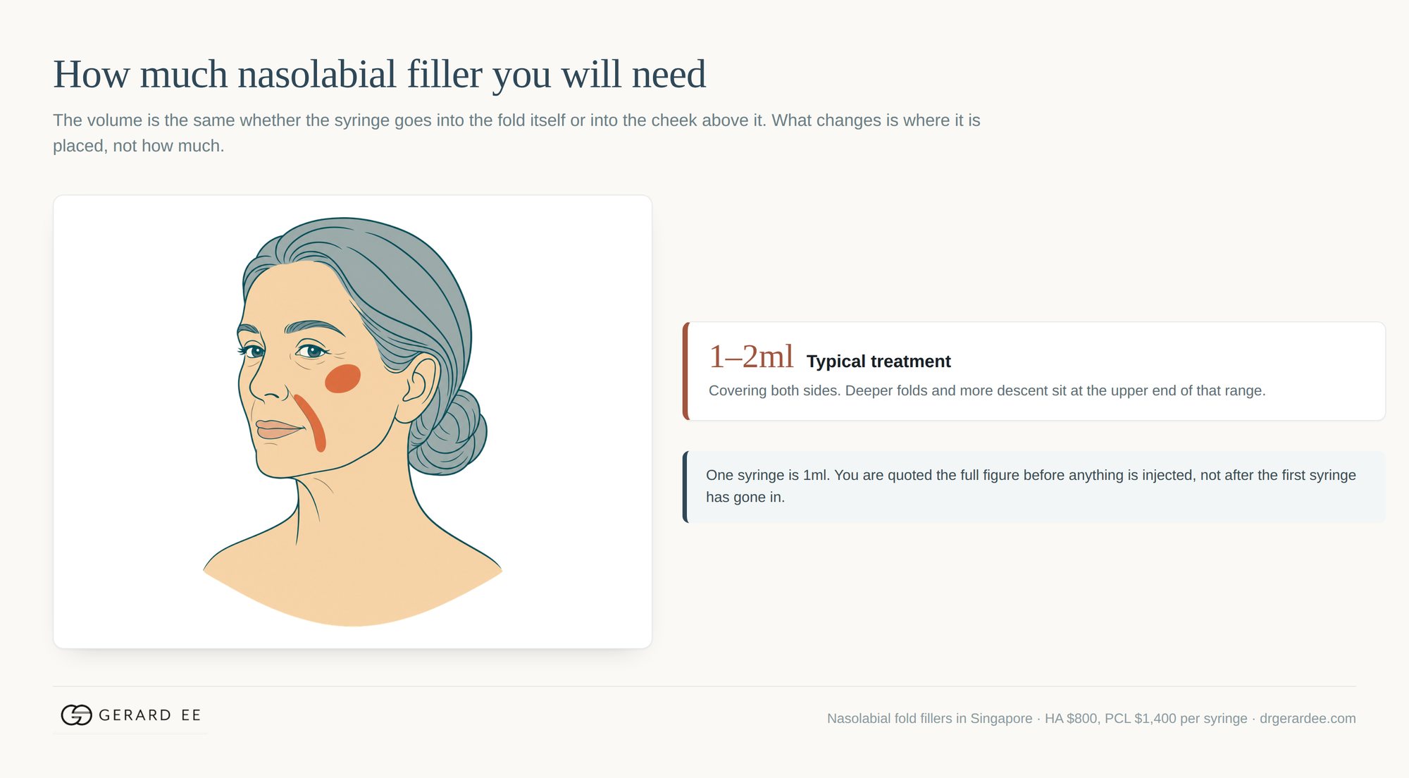 How much nasolabial filler is needed: 1 to 2ml covering both sides