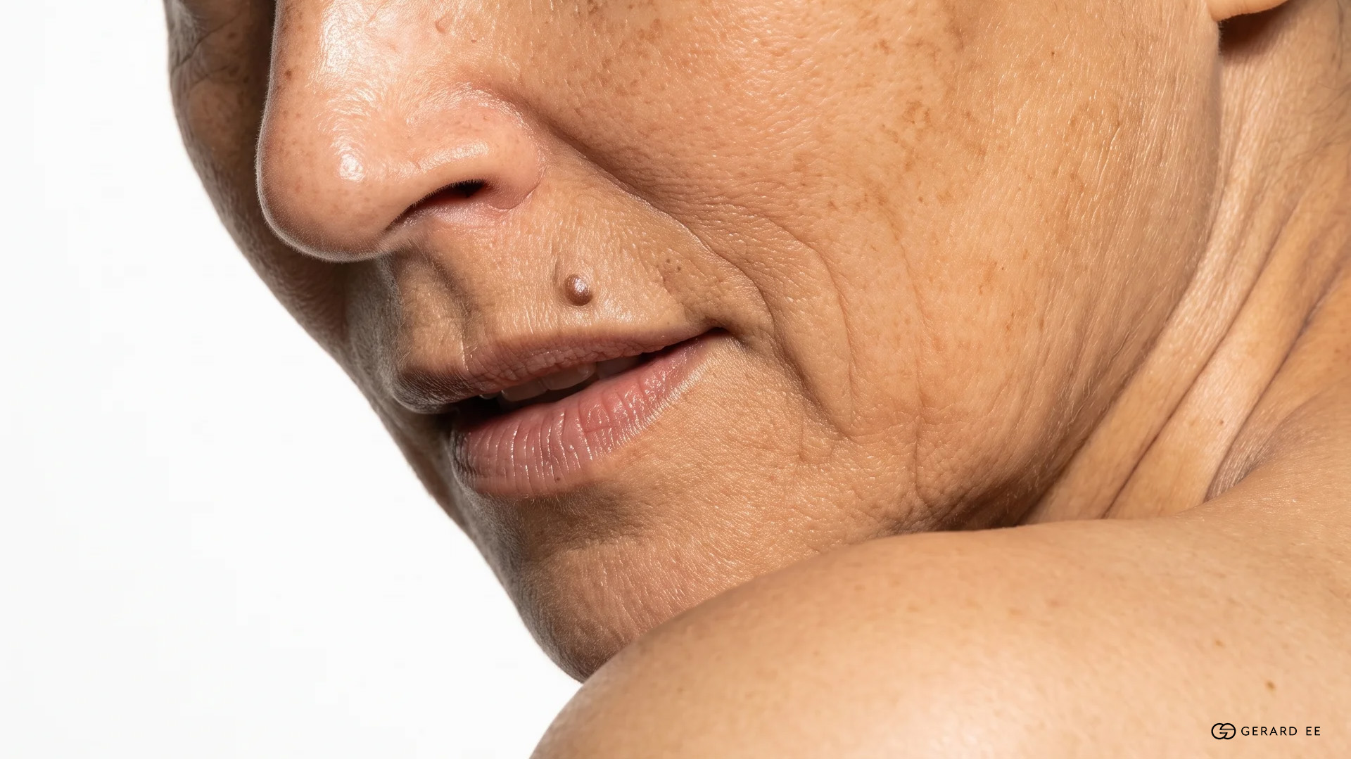 Nasolabial Fold Fillers in Singapore