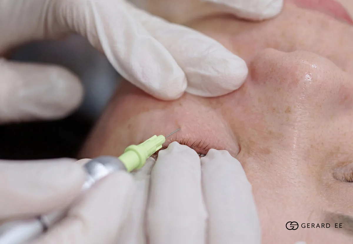 Non-surgical eye bag removal with AGNES: insulated microneedle applied to the lower eyelid fat pad