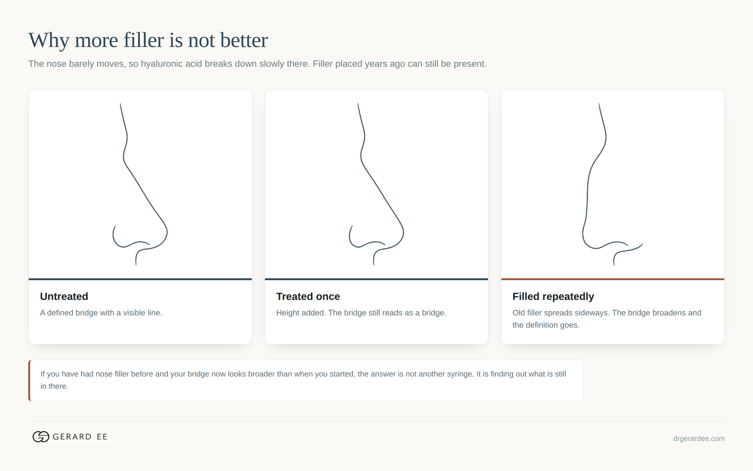 How repeated nose filler broadens the nasal bridge over time