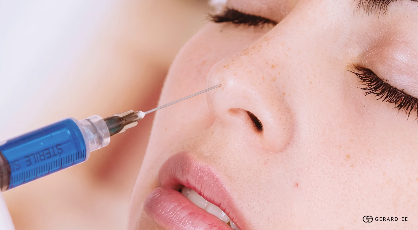 nose fillers sg
