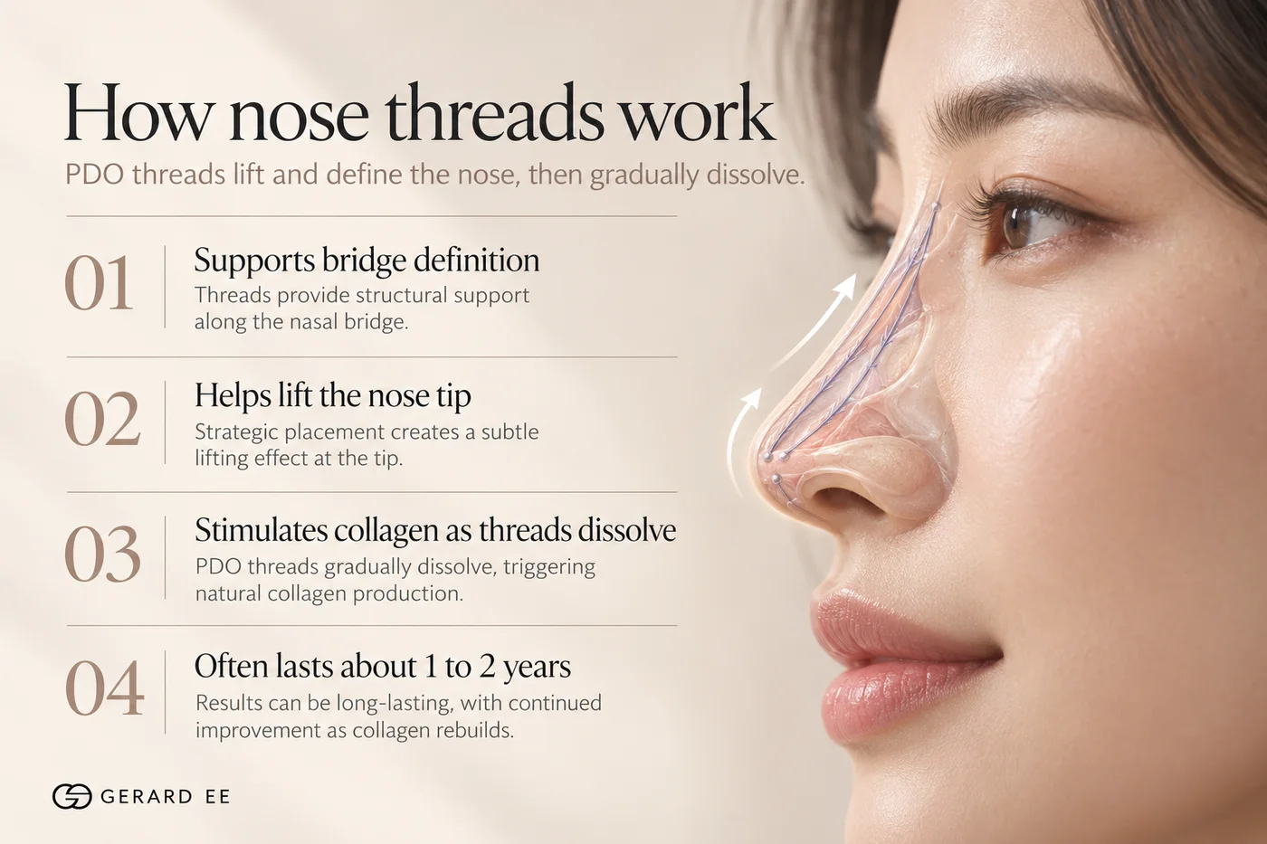 How nose threads work: PDO threads support the bridge, lift the nose tip and stimulate collagen as they dissolve, lasting about 1 to 2 years