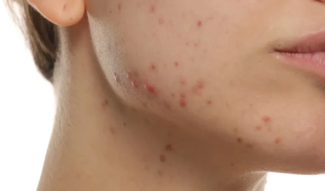 Singapore humidity data in relation to oily skin and acne