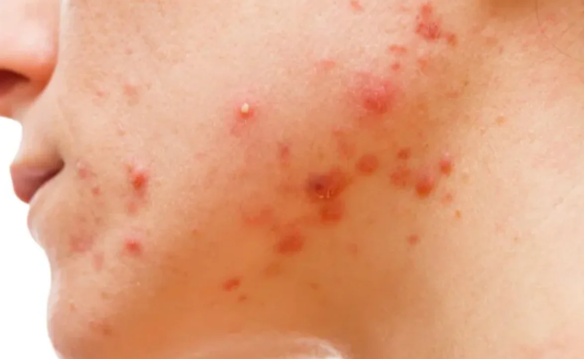 Acne Treatment for Oily Skin in Singapore’s Humid Weather