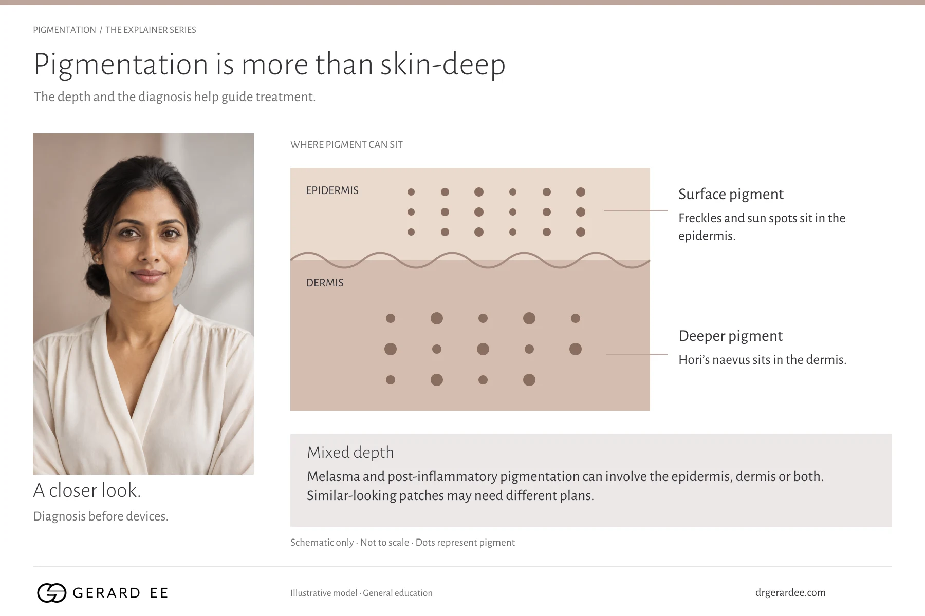 Where pigment sits in the skin: freckles and sun spots in the epidermis, Hori's naevus in the dermis, melasma and post-inflammatory pigmentation at mixed depth