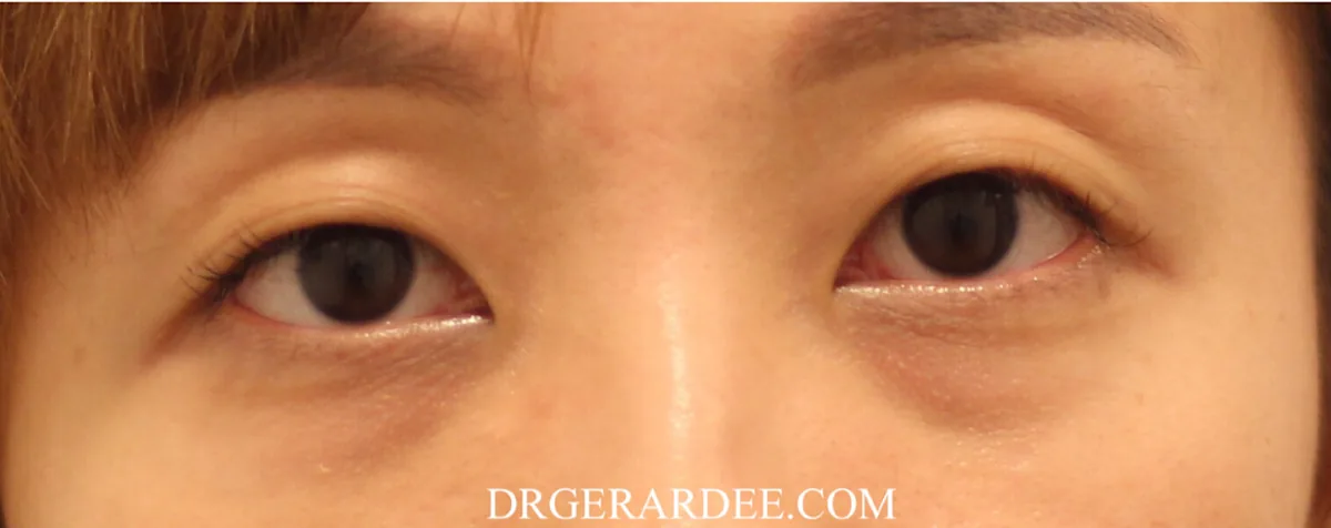 Pigmented dark eye circles with mild lower eyelid fullness