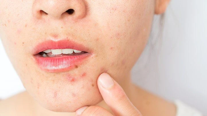 Acne treatment with the Plason plasma facial in Singapore