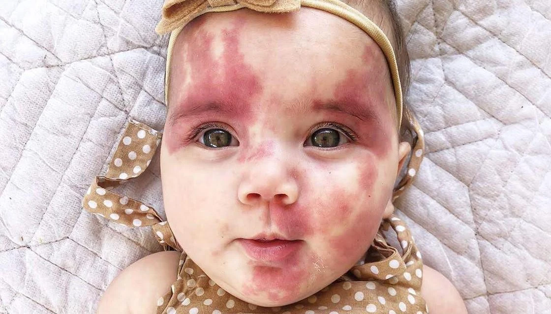 Port wine stain birthmark compared with a haemangioma
