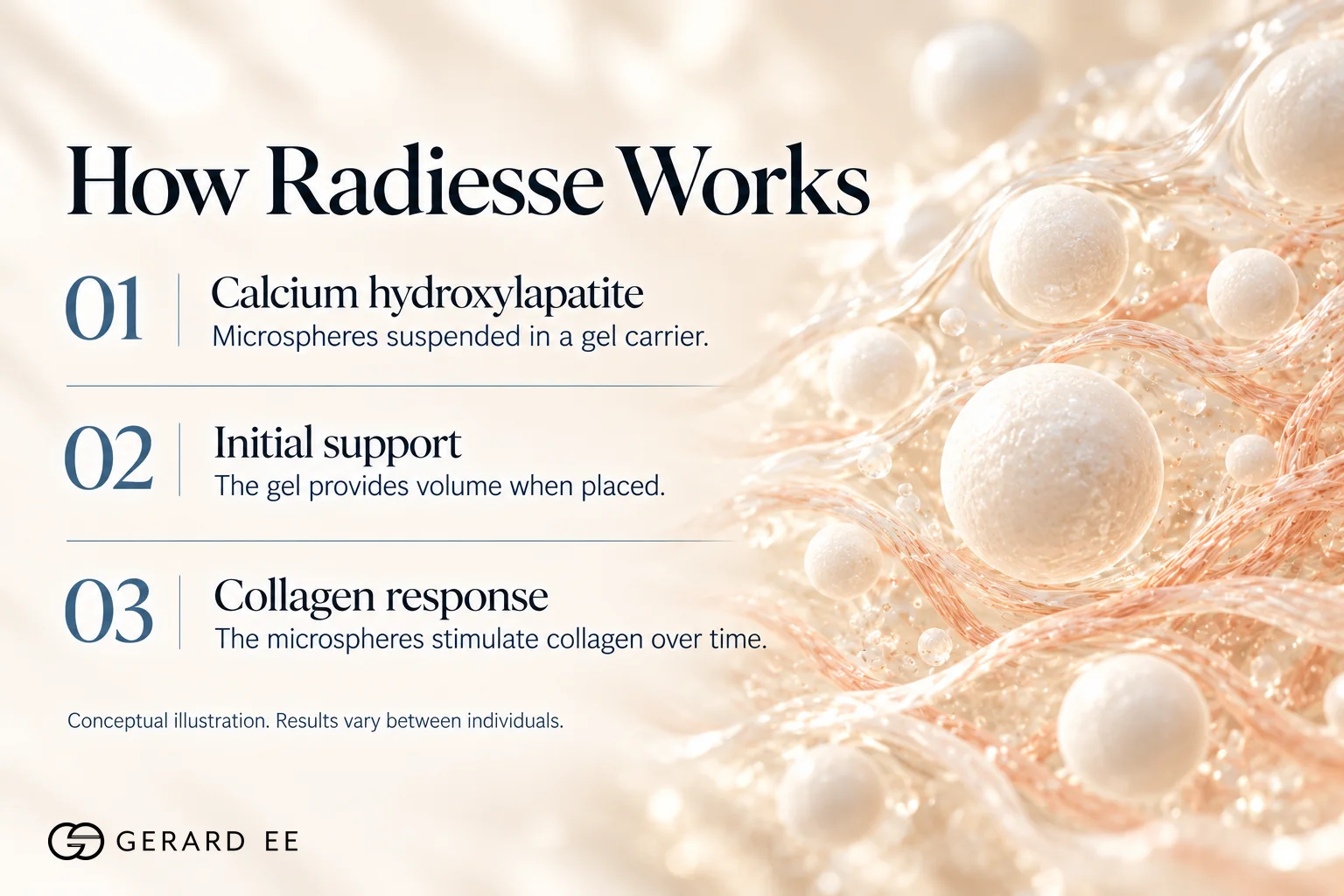 How Radiesse nose filler works, calcium hydroxylapatite microspheres that stimulate collagen