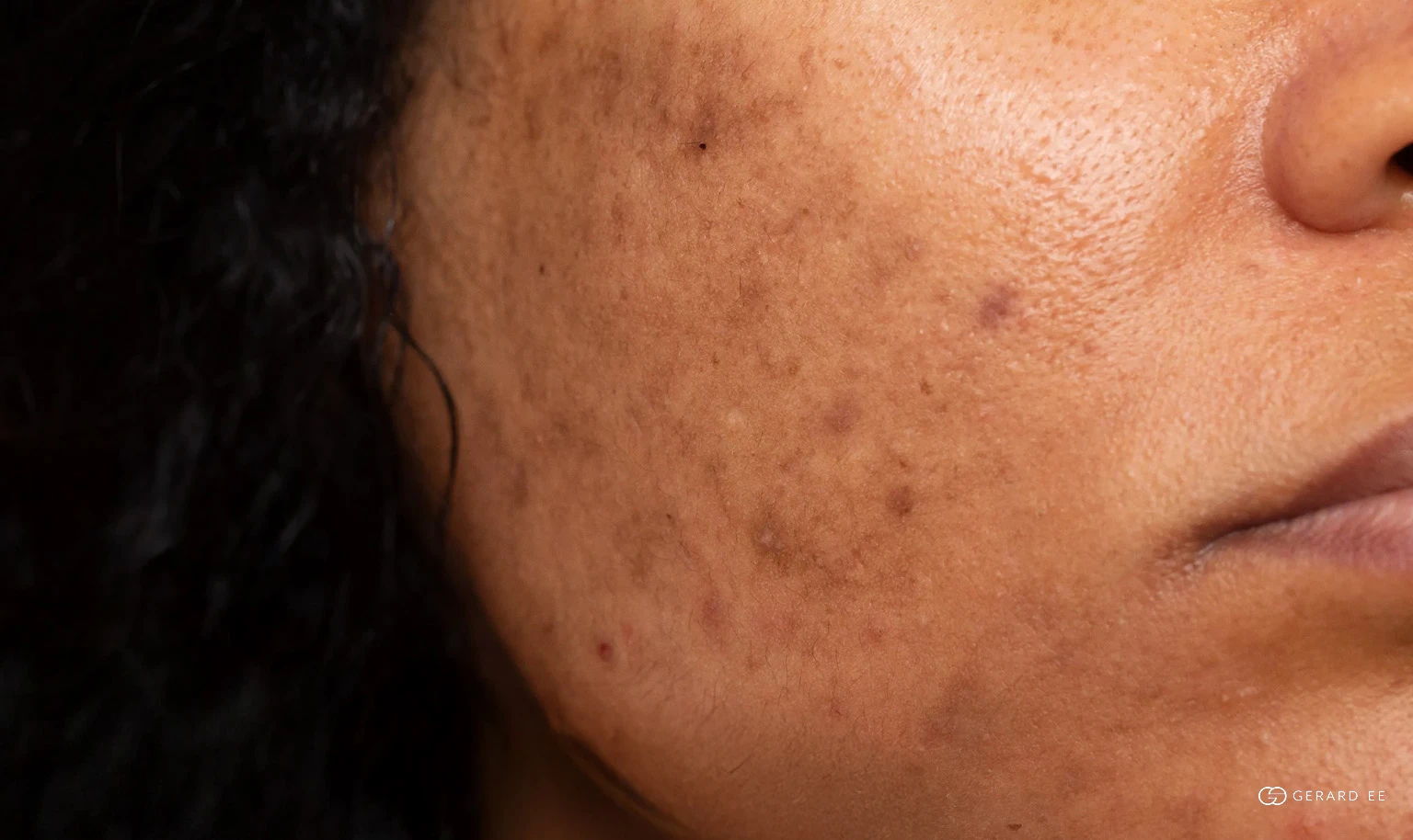 red marks Post-inflammatory erythema, red acne marks