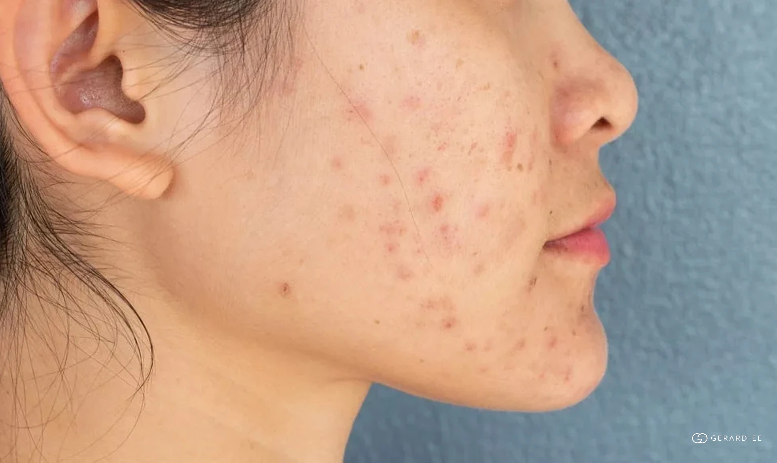 Red and brown acne marks after breakouts