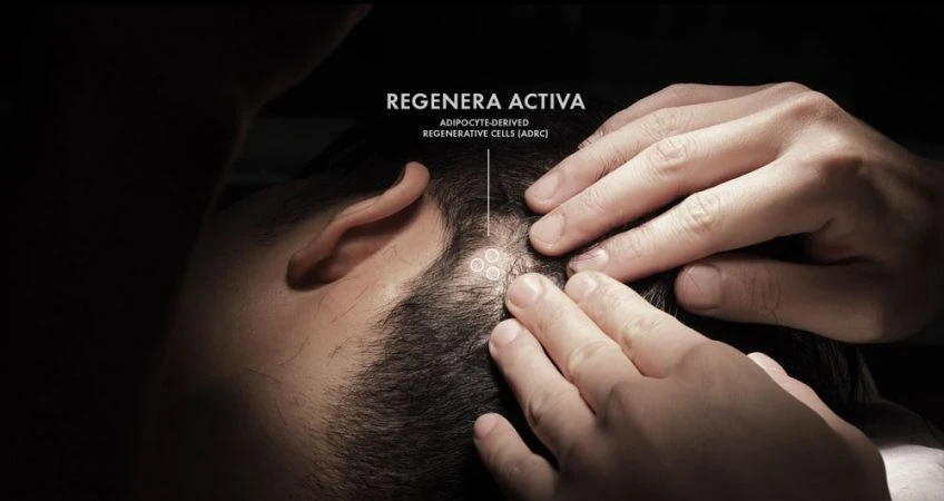 Regenera Activa hair regeneration treatment at the clinic in Singapore