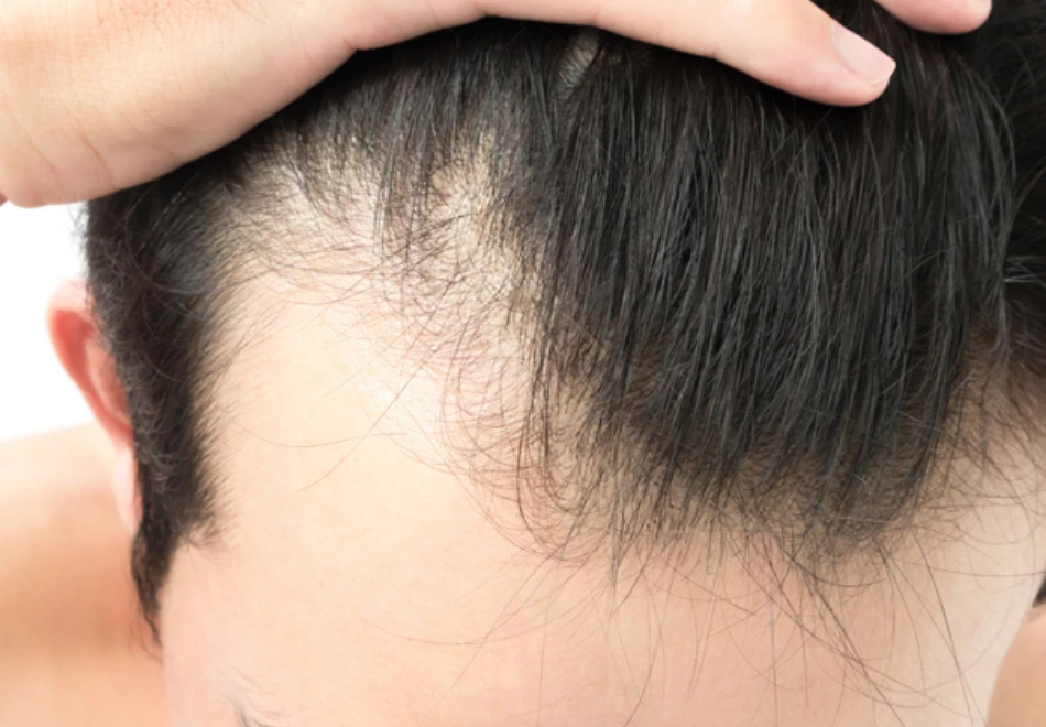Male pattern hair loss before Regenera Activa treatment in Singapore