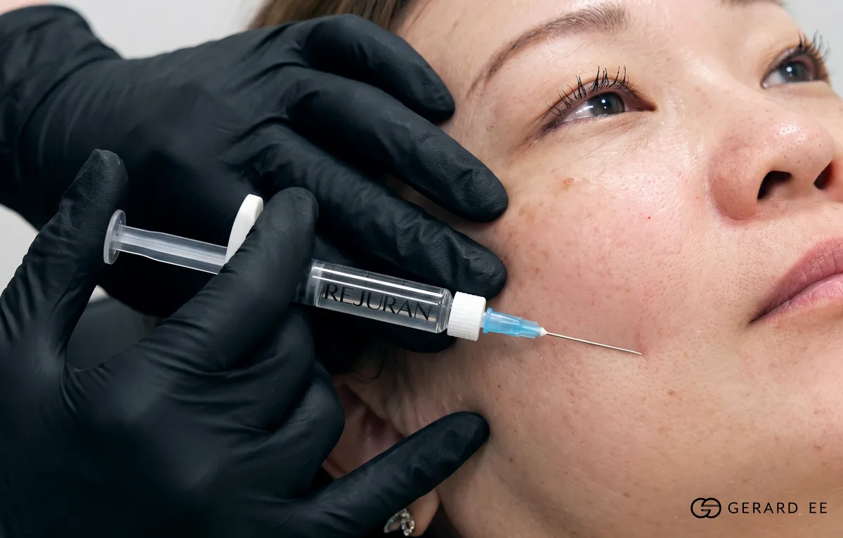 Rejuran polynucleotide injection under the eye, a skin-quality adjunct rather than an eye bag treatment