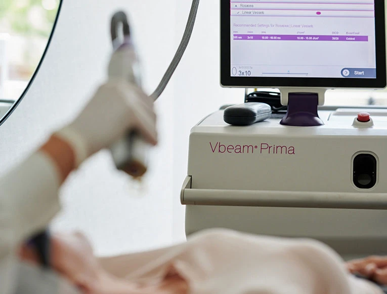 Pulsed dye laser used to treat rosacea