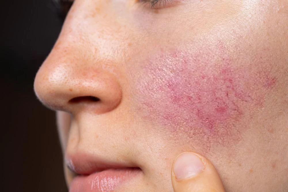 Facial redness and flushing in rosacea