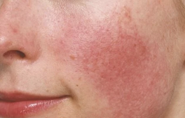 Facial redness from rosacea in Singapore