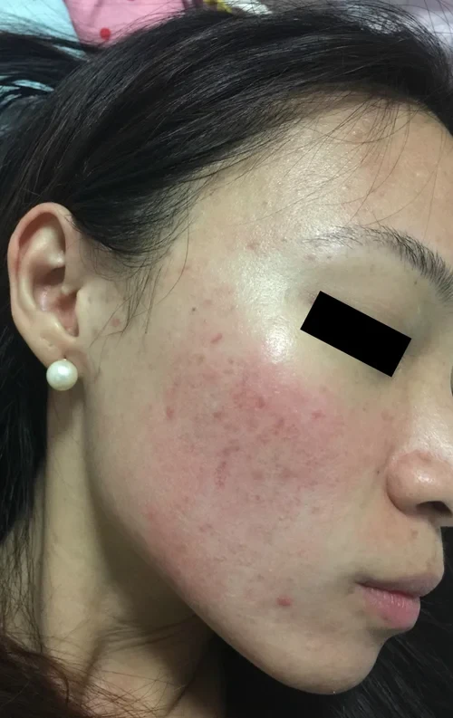 rosacea vbeam laser V Beam pulsed dye laser treatment for rosacea in Singapore