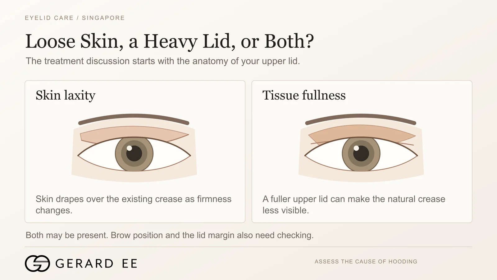 Sagging eyelid from loose skin compared with a heavy upper eyelid from tissue fullness