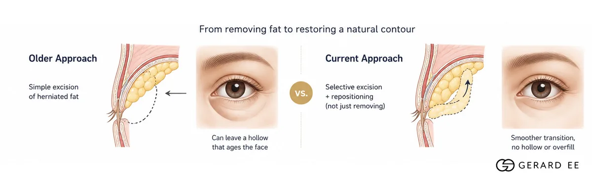 Scarless eye bag removal: older fat excision compared with selective excision and repositioning