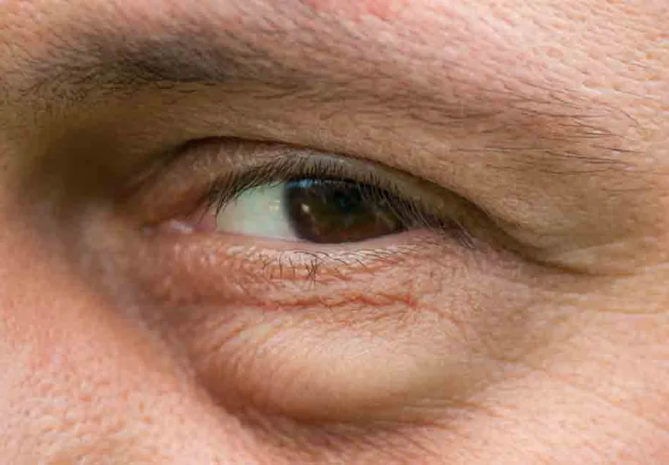 Scarless eye bag removal surgery in Singapore: lower eyelid eye bags
