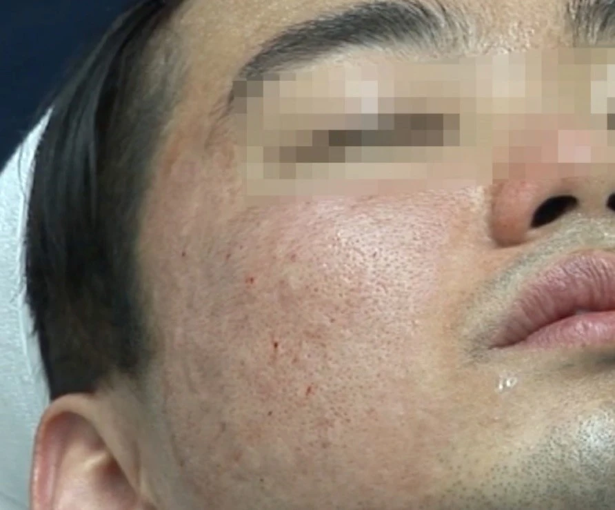 Rejuran polynucleotide injection treatment to the face