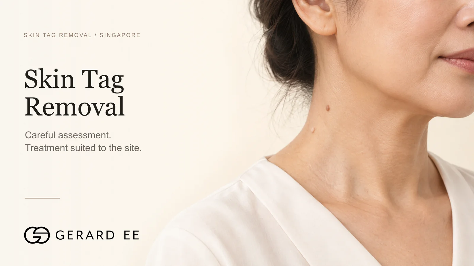 Skin tag removal in Singapore, careful assessment and treatment suited to the site