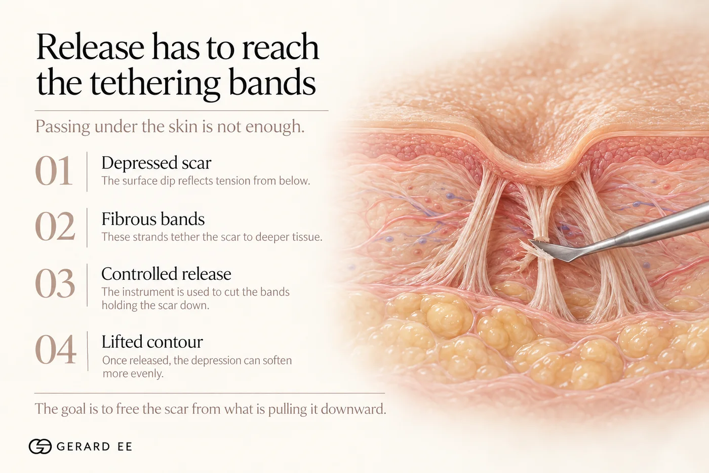 Subcision release has to reach the tethering bands beneath a depressed acne scar