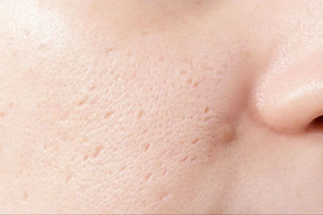 Rolling acne scar: a broad, soft-edged depression tethered from beneath, the main target of subcision