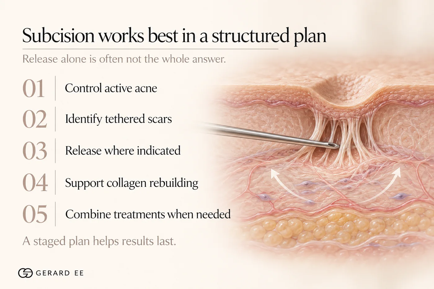 Subcision works best in a structured acne scar treatment plan