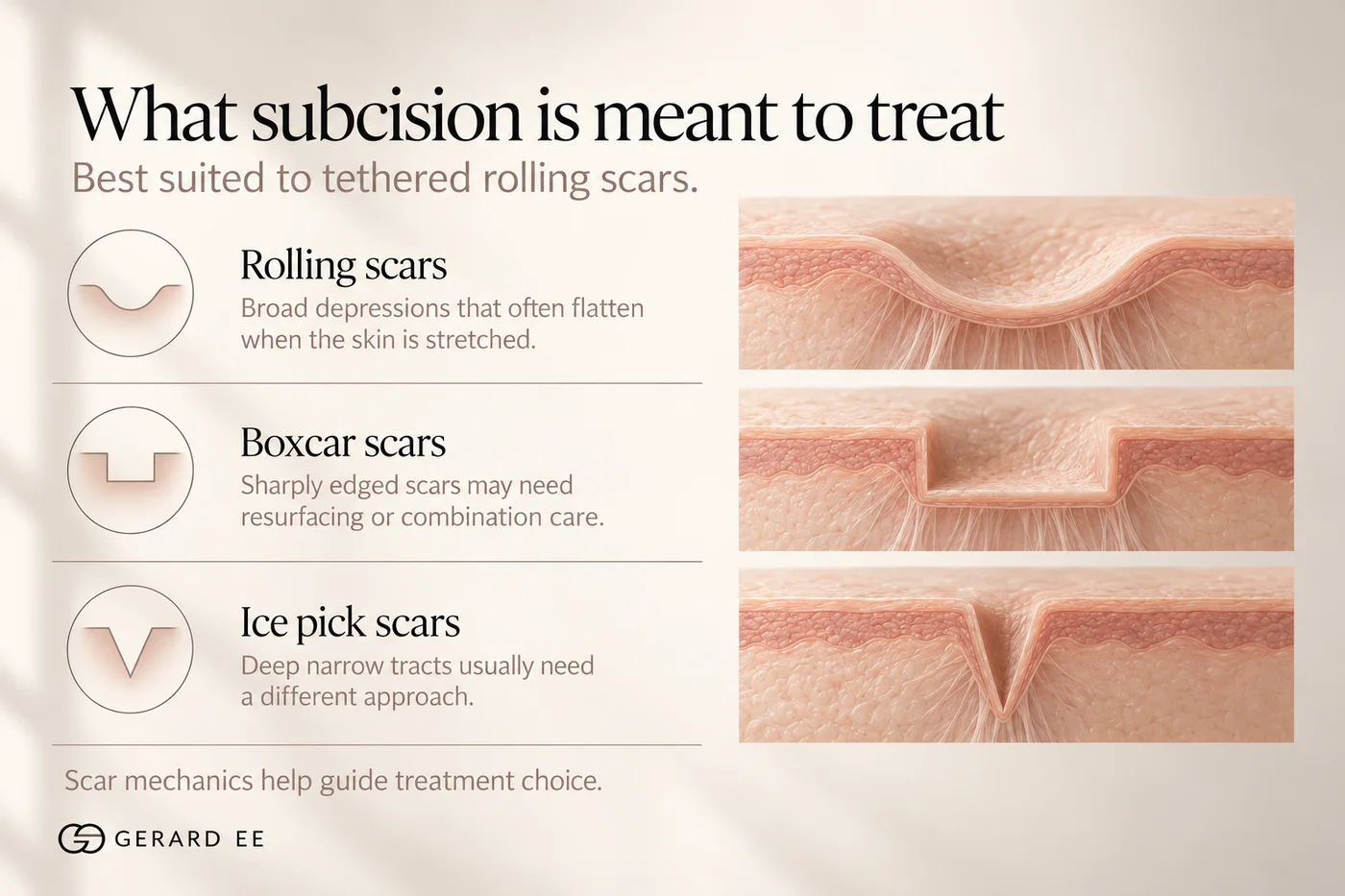 What subcision is meant to treat: rolling, boxcar and ice pick acne scars compared