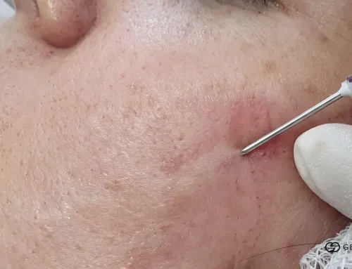Subcision and Biostimulators for Rolling Acne Scars