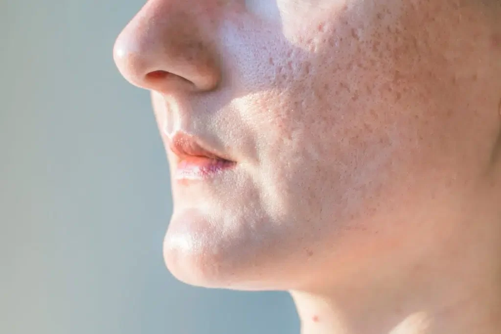 Boxcar acne scar: sharp vertical walls and a flat floor, suitable for subcision with resurfacing