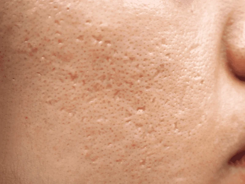 Ice pick acne scar: a narrow, deep pit treated with TCA CROSS alongside subcision