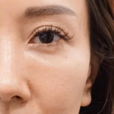 Sunken under-eye hollow creating the appearance of dark circles