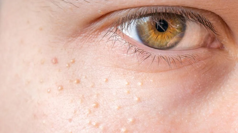 Syringoma treatment and removal, small skin-coloured bumps around the eye