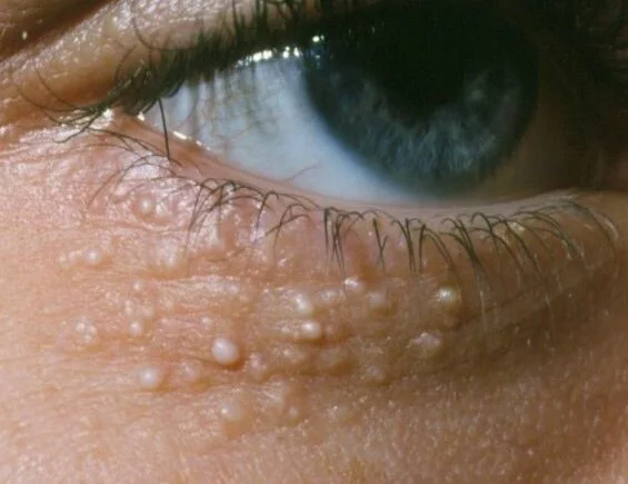 What are syringomas? (Syringoma Treatment With Agnes and Edge Fractional CO2 Laser – What Are Syringomas and How Can You Remove Them)