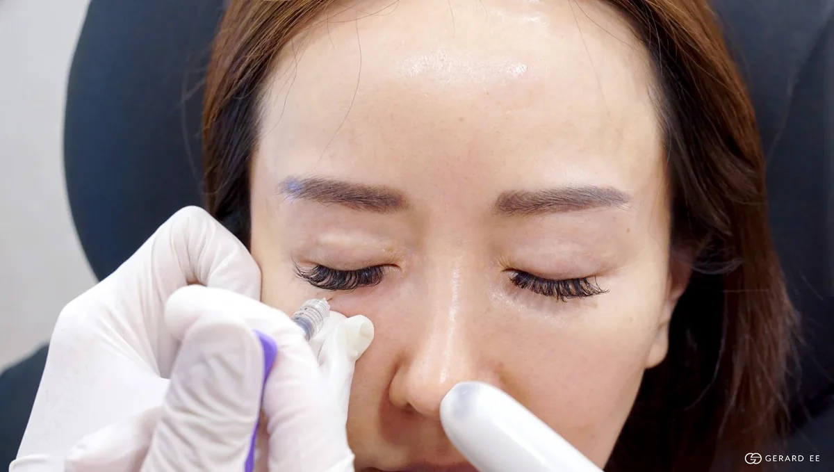 Tear trough filler injection; when filler is the wrong treatment for a true eye bag