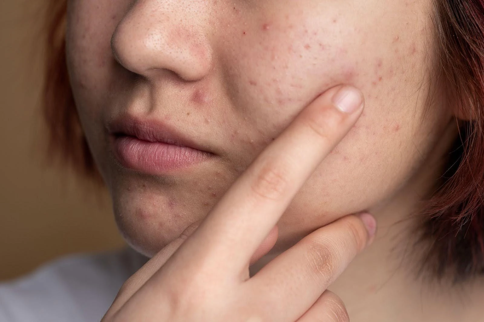 Microneedling for acne scars after teenage acne