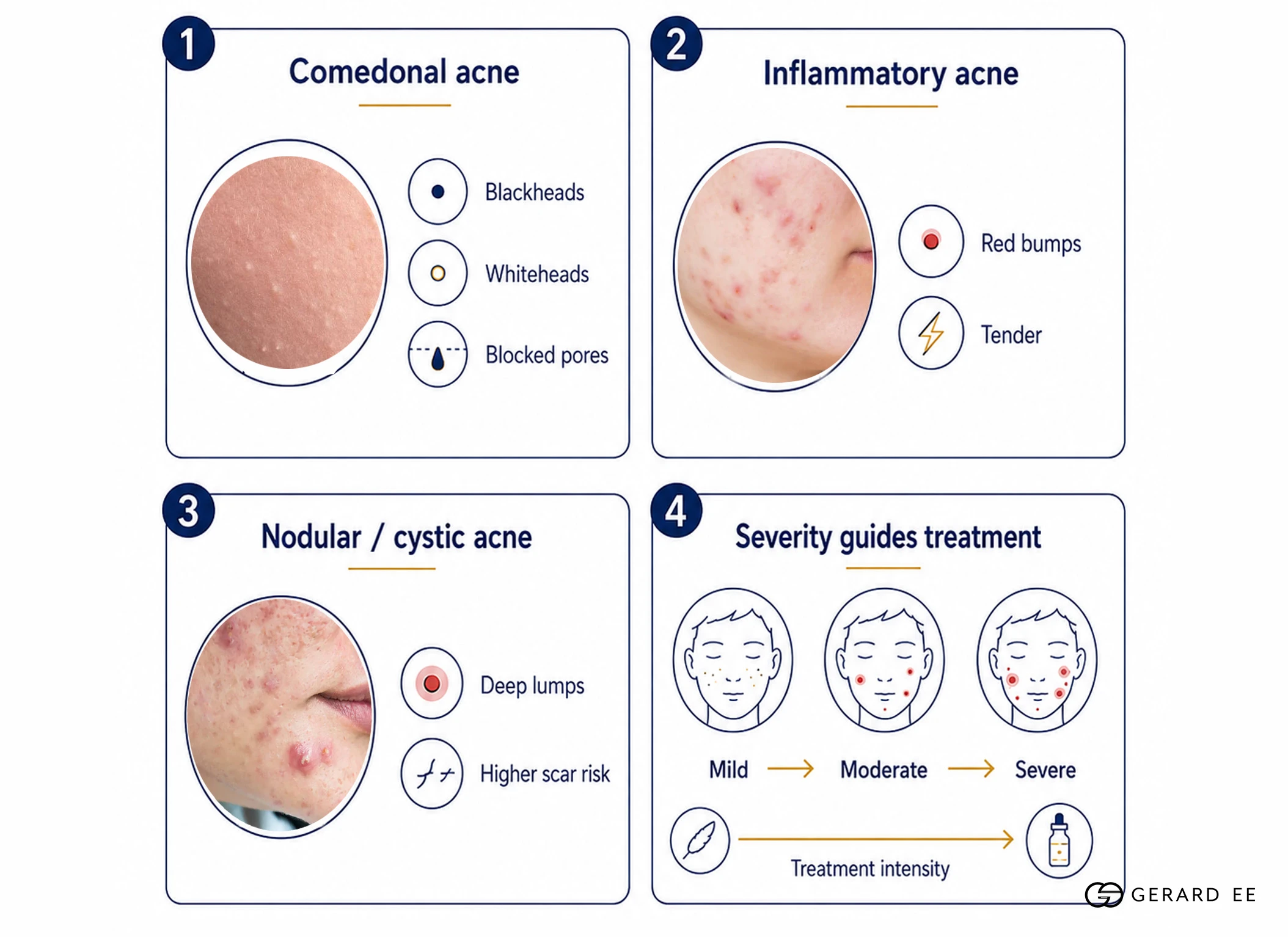 types of acne dge Types of acne lesions in teenagers