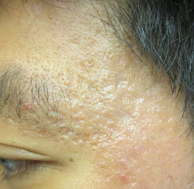 Acne scarring at the temple