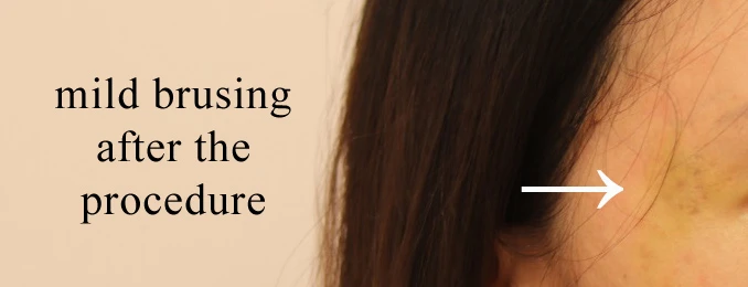 Thread lift treatment for temple acne scars in Singapore