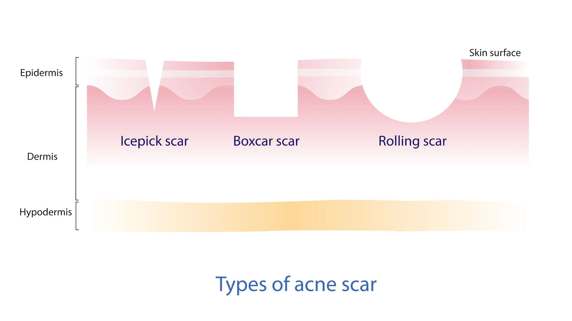 Ice pick, boxcar and rolling acne scar types