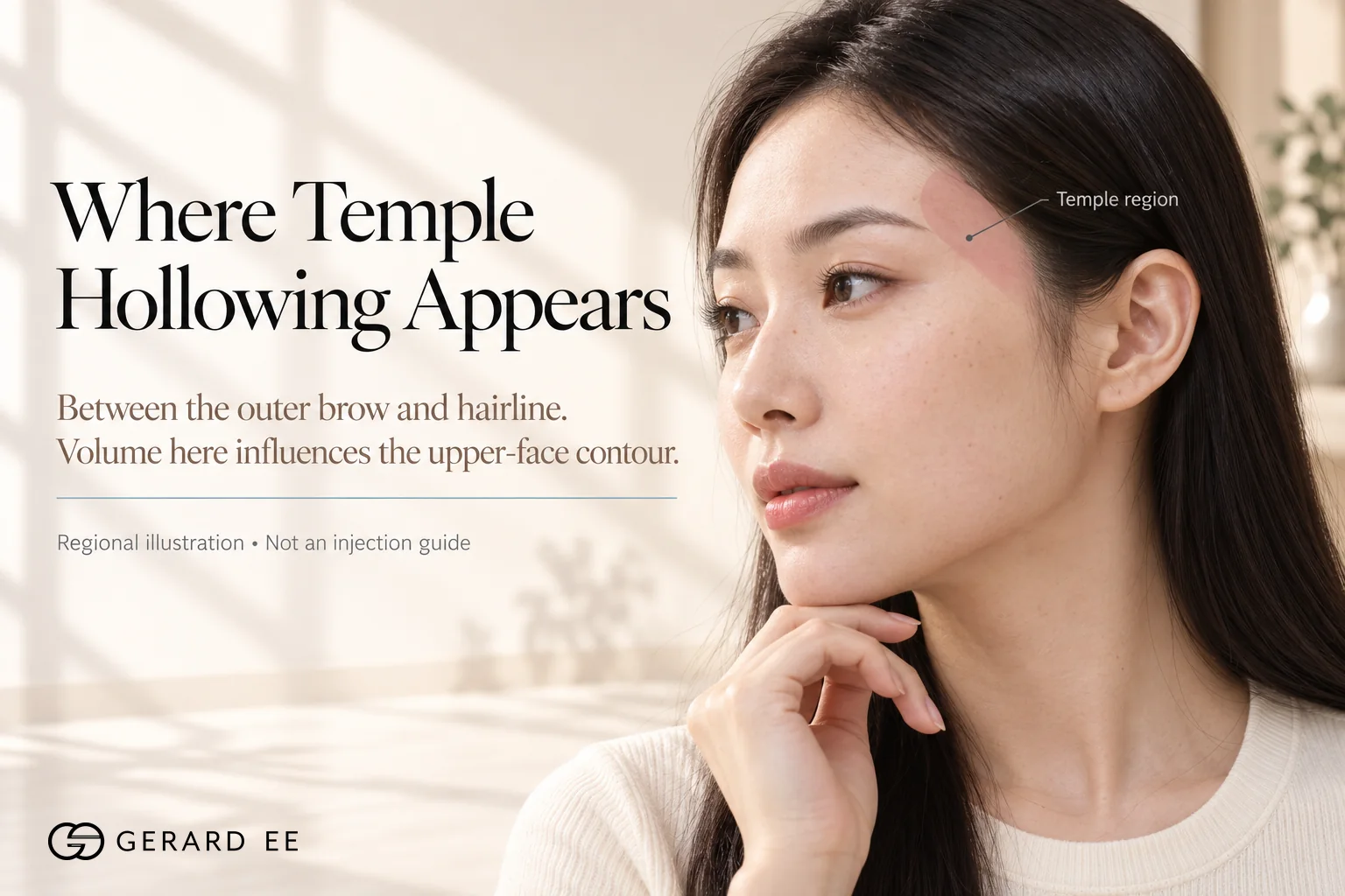 Where temple hollowing appears, between the outer brow and the hairline