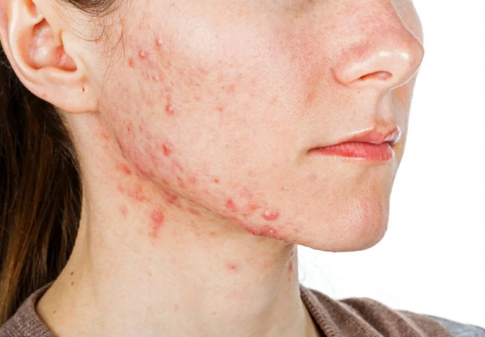 Thermage for acne in Singapore, inflammatory acne along the jawline